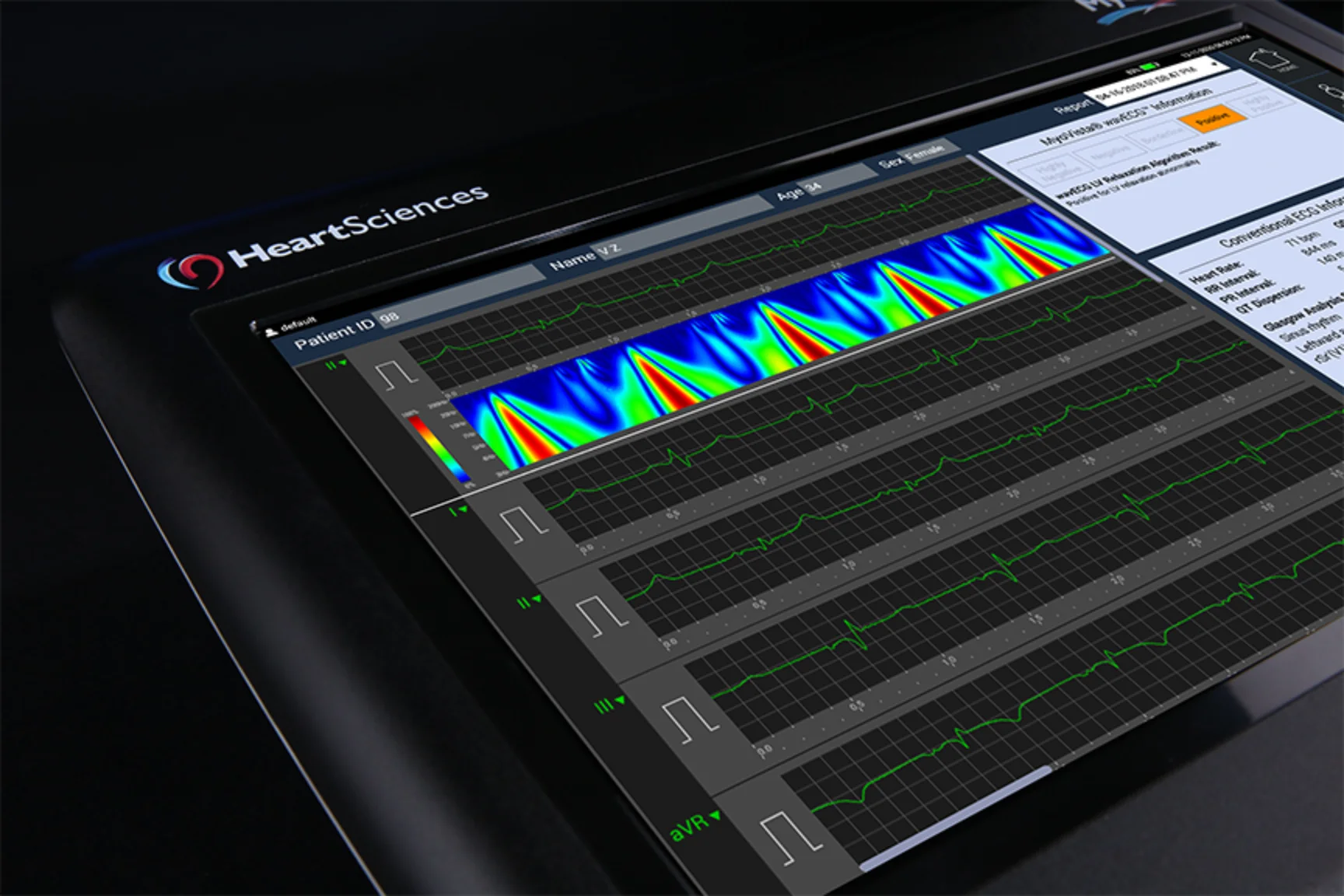 MyoVista® wavECG™ Device - AI-Enhanced 12-Lead ECG